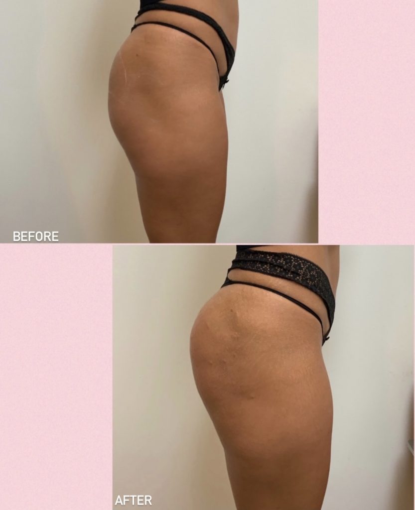 Before and after Sculptra® buttock lift results
