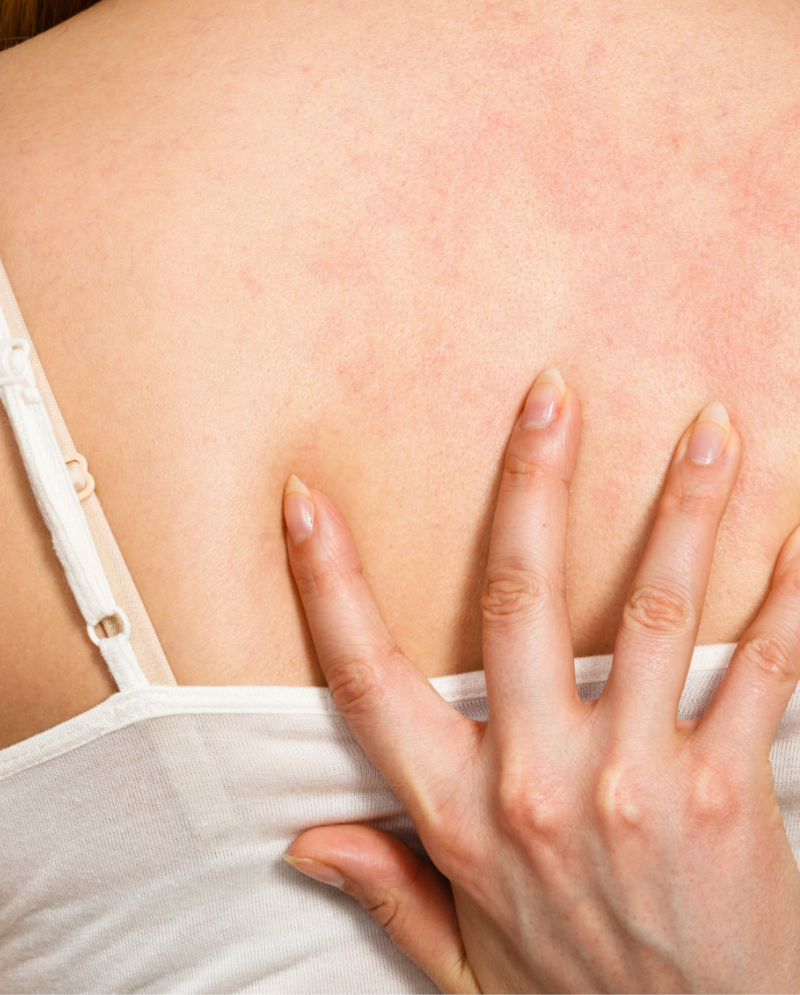 Rash caused by allergies on woman's back