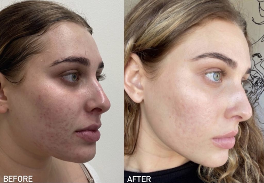 Before and after microneedling results for a female patient
