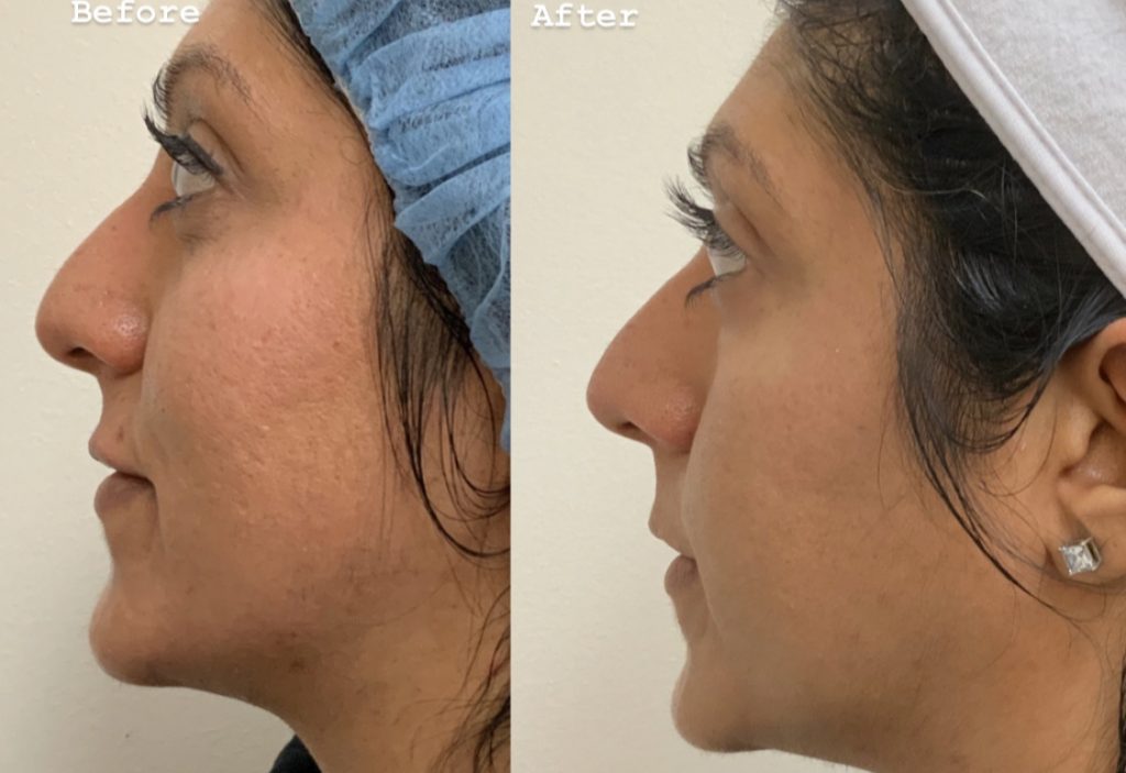 Before and after Microneedling + PRP results