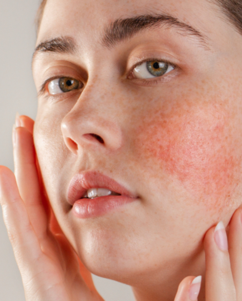 Rosacea on a woman's face