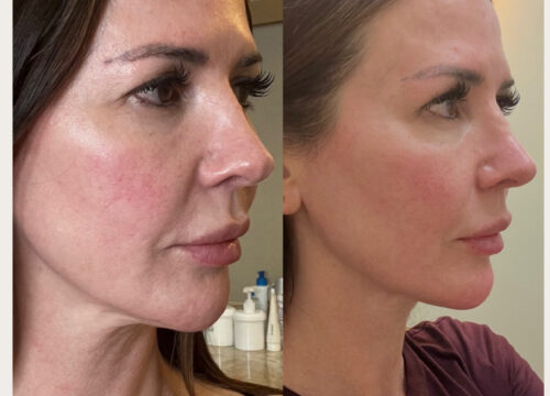 XERF Skin Tightening