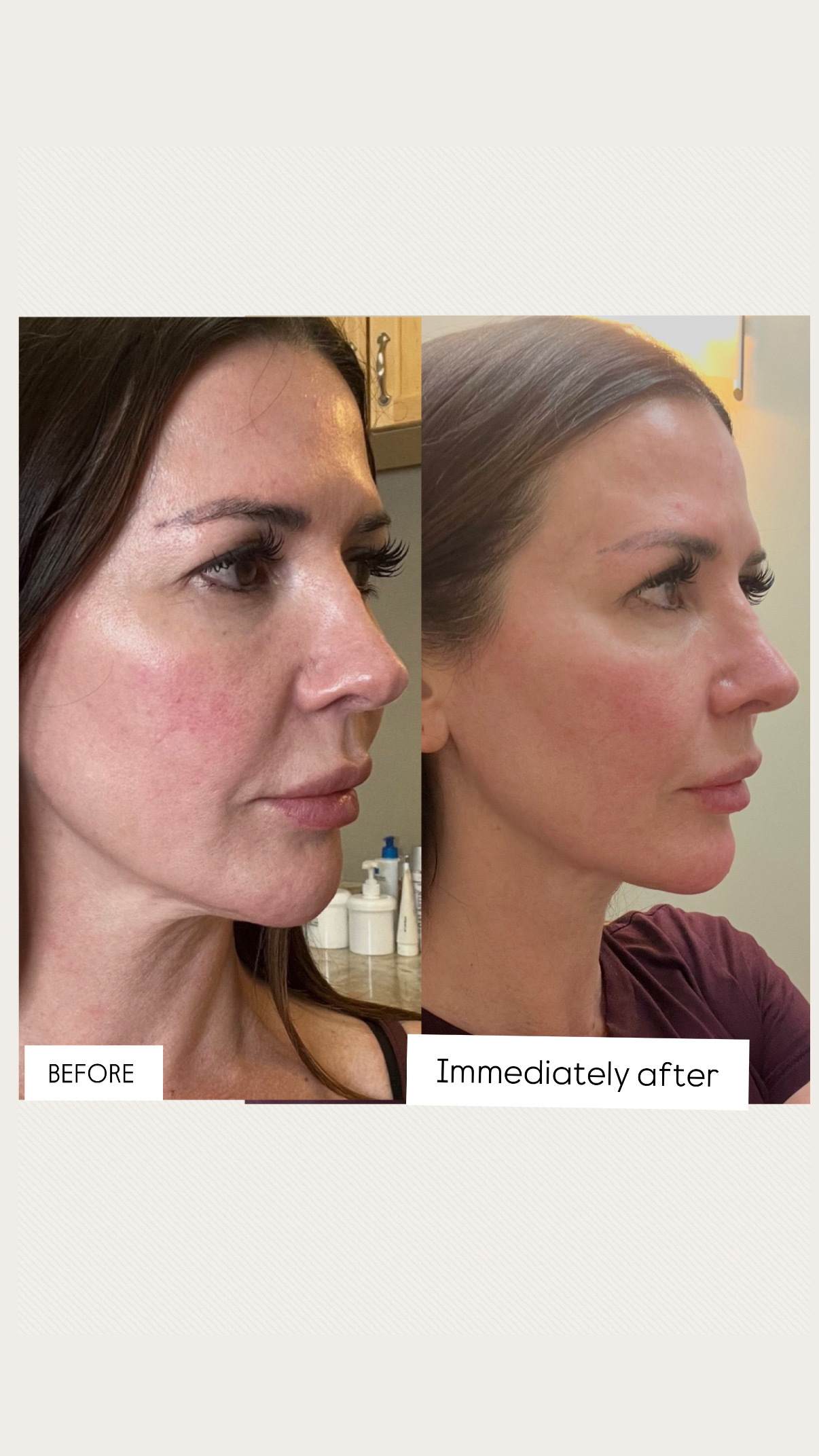 The Complete Guide to XERF Skin Tightening in Los Angeles