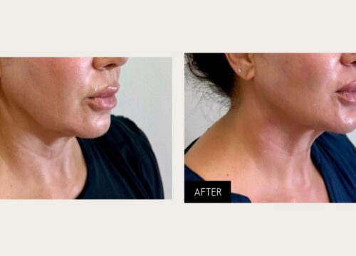 Before and after XERF radiofrequency skin tightening along the jawline